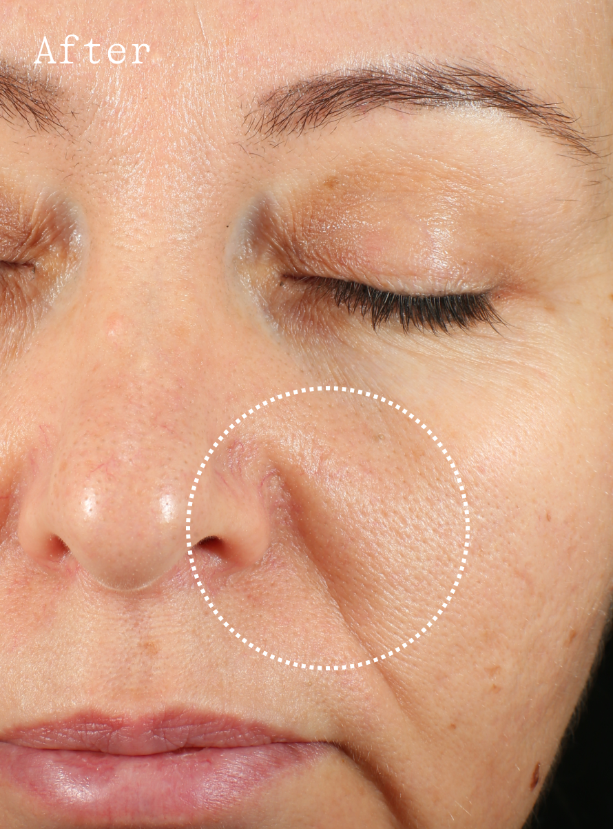 Client 2 after Dr. Marnie Wrinkle Pen — visibly smoother skin around the cheek and nasolabial area.