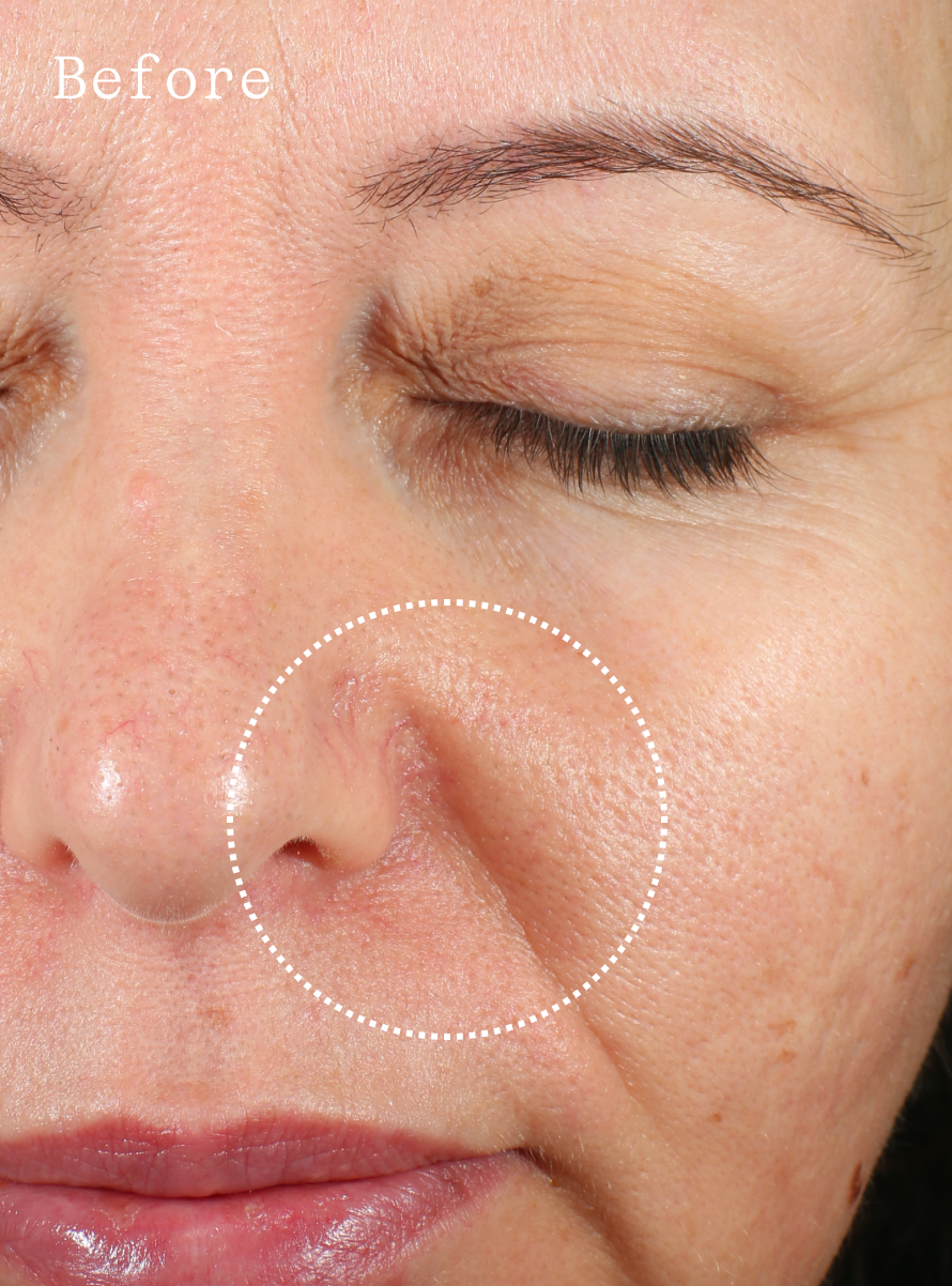Client 2 before Dr. Marnie Wrinkle Pen — baseline view of skin around the cheek and nasolabial area.