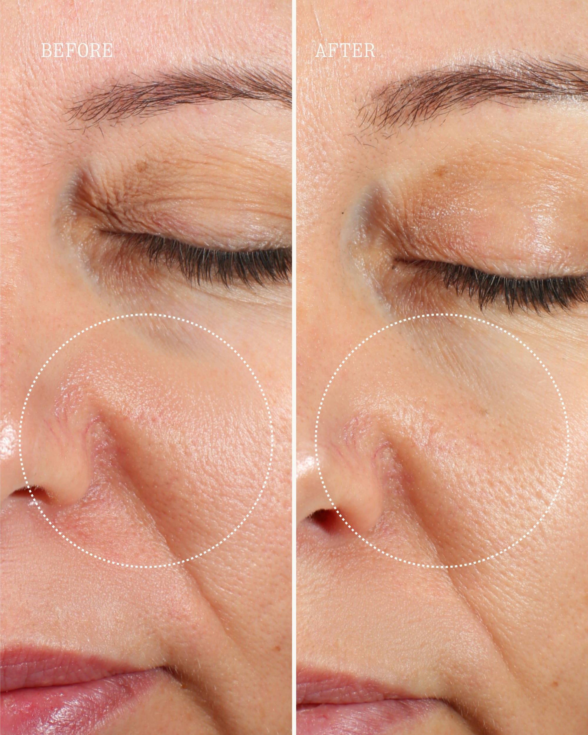 Before and after close-up of a woman's eye area showing reduced crow's feet and smoother skin texture after using the Wrinkle Pen