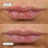 Before and after 4 weeks: stacked close-ups of the same lips, the after image looking fuller and smoother.