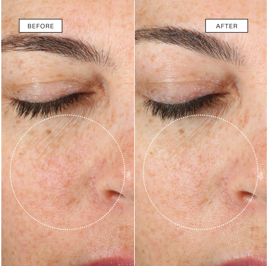 A side-by-side paired close-up of the same eye and cheek area, each half labelled and with a dotted circle highlighting the cheek