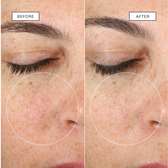 A side-by-side paired close-up of the same eye and cheek area, each half labelled and with a dotted circle highlighting the cheek
