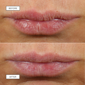 Stacked pair of clinical lip close-ups, the top showing vertical lip lines and the bottom showing smoother, fuller lips
