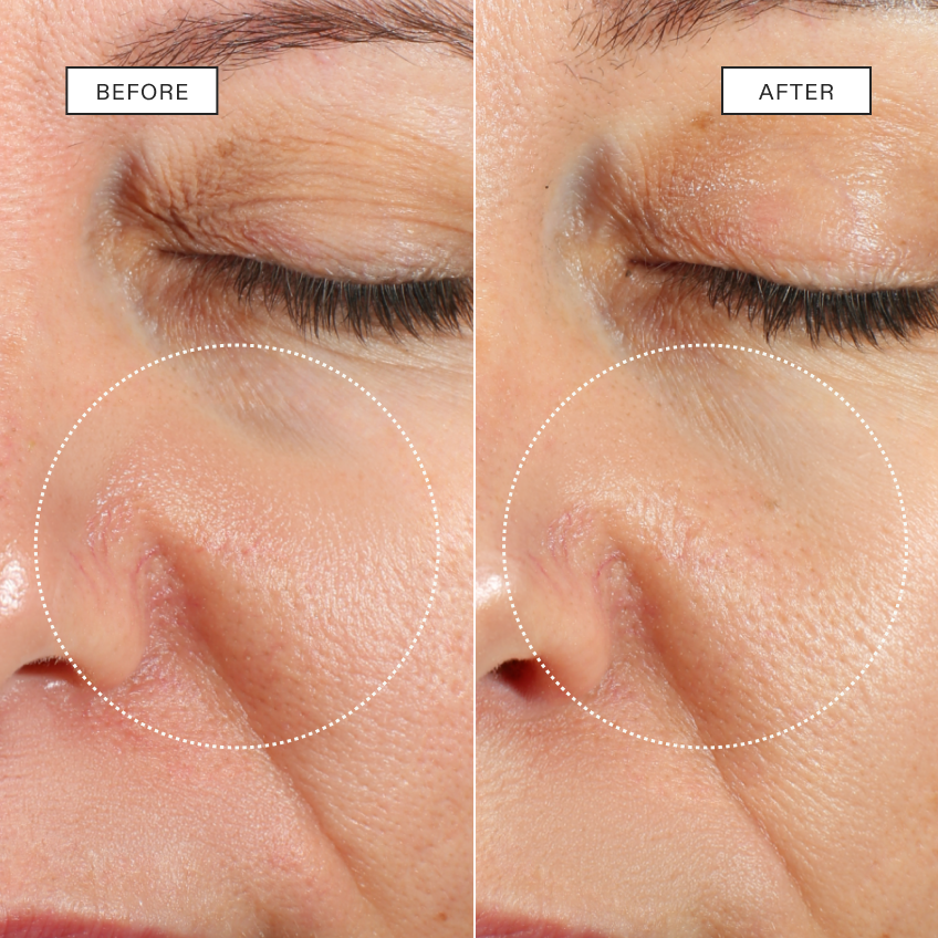Side-by-side paired close-ups of the same under-eye and nasolabial area with dotted focus circles, labelled BEFORE on the left and AFTER on the right